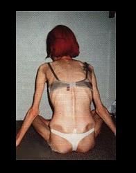 Click image for larger version. 

Name:	anorexia_396.jpg 
Views:	5956 
Size:	12.5 KB 
ID:	59778