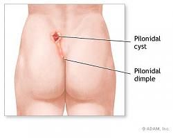 Click image for larger version. 

Name:	pilonidalcyst_174.jpg 
Views:	3464 
Size:	33.2 KB 
ID:	289130