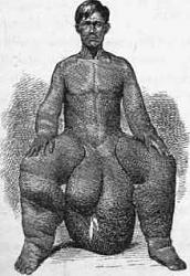 Click image for larger version. 

Name:	Elephantiasis-affecting-scrotum-legs-and-arms-After-photo.jpg 
Views:	3263 
Size:	9.0 KB 
ID:	567861